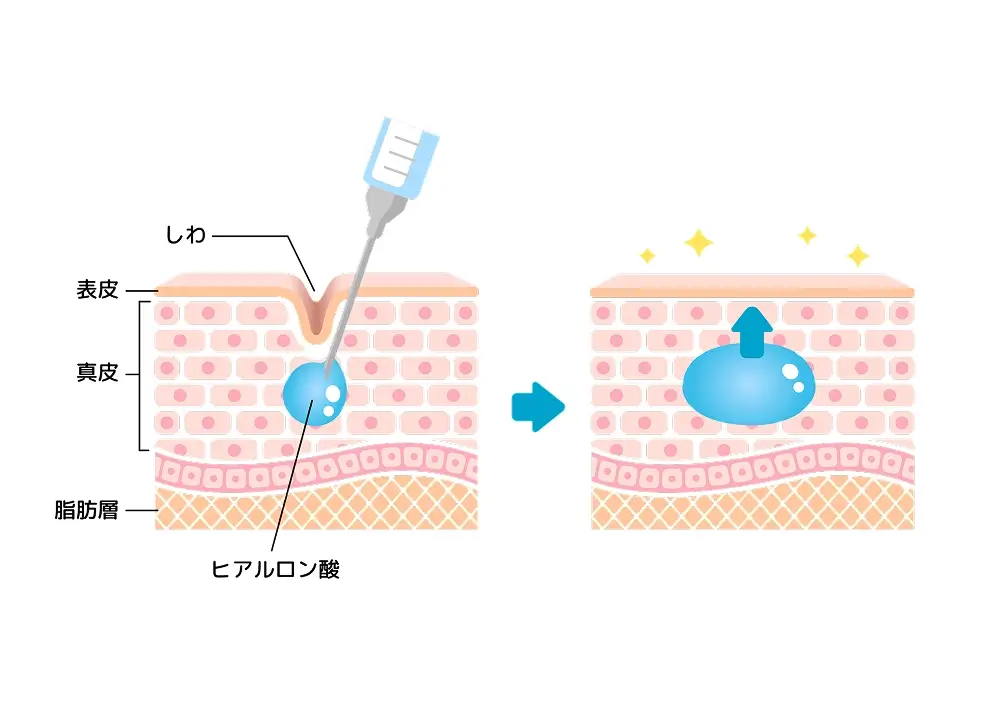 ヒアルロン酸について