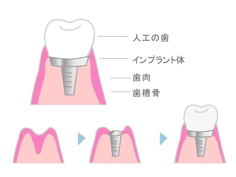 インプラント治療とは