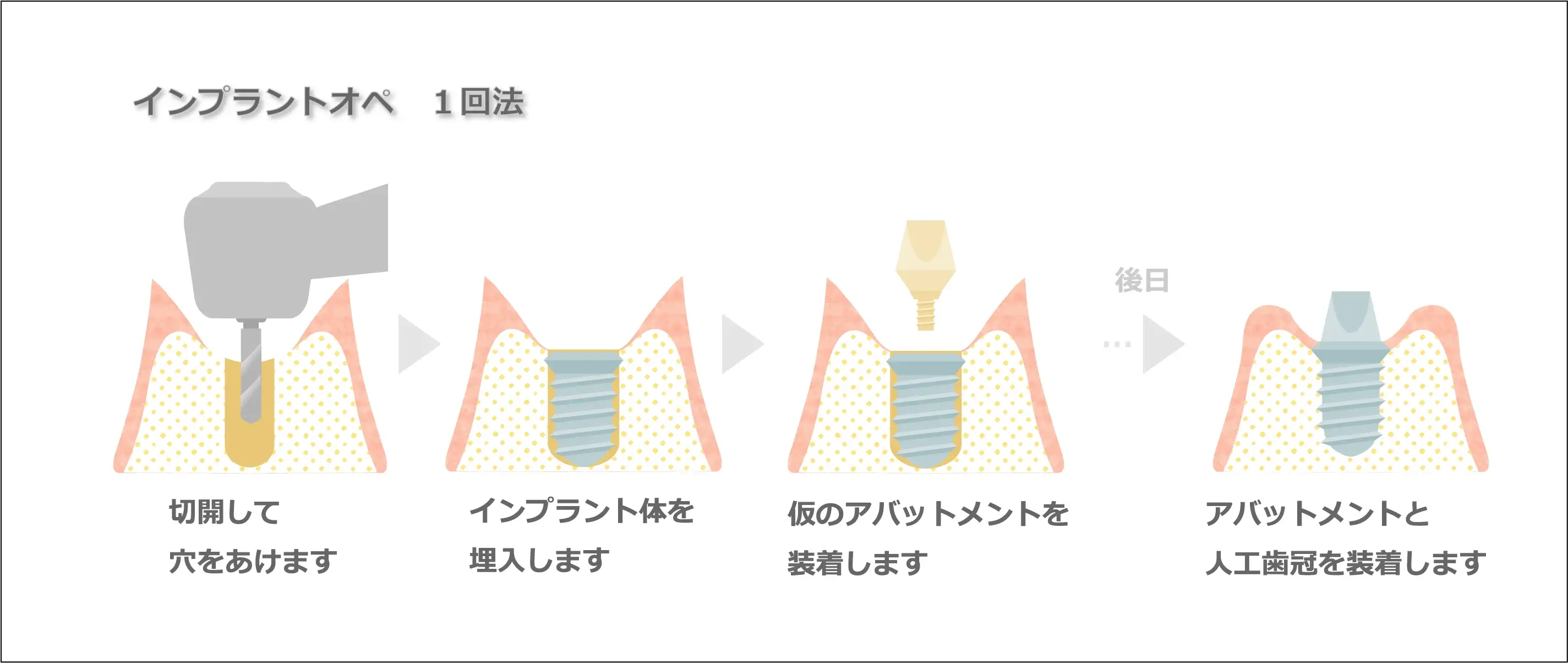 インプラントの治療の流れ